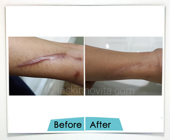 Surgical Scars removal Gurgaon