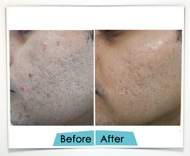 Acne Scars removal