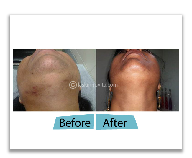 Laser hair removal in Gurgaon, full body laser | La Skinnovita